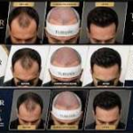 Doctor-Led Hair Restoration and The…