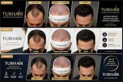 Doctor-Led Hair Restoration and The Science Behind Hairline Design